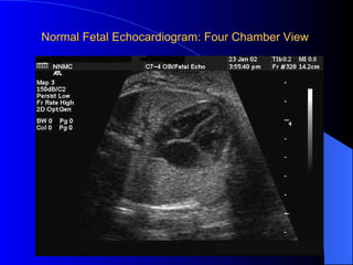 Normal Fetal Echocardiogram: Four Chamber View 