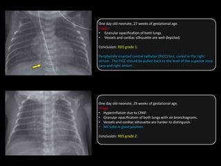 One day old neonate, 27 weeks of gestational age.
Image
• Granular opacification of both lungs.
• Vessels and cardiac silhouette are well depicted.
Conclusion: RDS grade 1.
Peripherally inserted central catheter (PICC) line, curled in the right
atrium. The PICC should be pulled back to the level of the superior vena
cava and right atrium.
One day old neonate, 29 weeks of gestational age.
Image
• Hyperinflation due to CPAP.
• Granular opacification of both lungs with air bronchograms.
• Vessels and cardiac silhouette are harder to distinguish.
• NG tube in good position.
Conclusion: RDS grade 2.
 