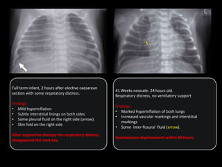 Full term infant, 2 hours after elective caesarean
section with some respiratory distress.
Findings:
• Mild hyperinflation
• Subtle interstitial linings on both sides
• Some pleural fluid on the right side (arrow).
• Skin fold on the right side
After supportive therapy the respiratory distress
disappeared the next day.
41 Weeks neonate. 24 hours old.
Respiratory distress, no ventilatory support
Findings:
• Marked hyperinflation of both lungs
• Increased vascular markings and interstitial
markings
• Some inter-fissural fluid (arrow).
Spontaneous improvement within 48 hours.
 