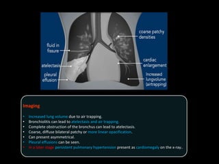 Imaging
• Increased lung volume due to air trapping.
• Bronchiolitis can lead to atelectasis and air trapping.
• Complete obstruction of the bronchus can lead to atelectasis.
• Coarse, diffuse bilateral patchy or more linear opacification.
• Can present asymmetrical.
• Pleural effusions can be seen.
• In a later stage persistent pulmonary hypertension present as cardiomegaly on the x-ray..
 