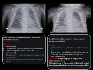 Chest film of a full term newborn with meconium
stained amniotic fluid.
Findings:
• Hyperinflation
• Course diffuse patchy consolidations on both sides.
• Some subtle pleural fluid on both sides
(arrowheads).
• Good position ETT. Superficial position NG tube, still
in esophagus.
• Deep position of umbilical vein line with tip in right
atrium.
Chest film of a full term newborn with meconium
stained amniotic fluid.
Findings:
• Good position of ETT, NG tube and umbilical vein
line.
• Course patchy consolidations with relative sparing
of the left apical lobe and right middle lobe.
• Mild hyperinflation.
Conclusion: chest radiograph in keeping with
meconium aspiration.
Without staining of the amniotic fluid the differential
diagnosis would include neonatal pneumonia or TTN.
 