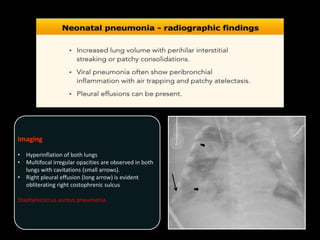 Imaging
• Hyperinflation of both lungs
• Multifocal irregular opacities are observed in both
lungs with cavitations (small arrows).
• Right pleural effusion (long arrow) is evident
obliterating right costophrenic sulcus
Staphylococcus aureus pneumonia.
 