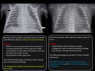 Neonate, GA 37+6 weeks, respiratory distress, treated
with CPAP after delivery. History of maternal infection.
Findings:
• Bilateral increased lung volume with asymmetric
increased opacification of the lungs with subtle
consolidation of right upper lobe (black arrow) and
left lower lobe (white arrow).
• Hyperinflation of left upper lobe.
This child developed signs of infection, both clinically
and in the laboratory findings.
The radiographic findings were attributed to neonatal
pneumonia.
A full term neonate, with respiratory distress after 24
hours.
Findings:
• Hyperinflation of both lungs and cardiac
enlargement with increased interstitial markings
and vascular markings. No pleural fluid.
The differential diagnosis includes TTN and neonatal
pneumonia.
After 48 hours there was no improvement of the
respiratory distress, and the neonate developed signs
of infection.
 