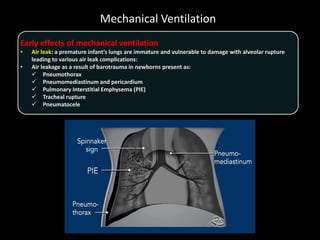 Mechanical Ventilation
Early effects of mechanical ventilation
• Air leak: a premature infant’s lungs are immature and vulnerable to damage with alveolar rupture
leading to various air leak complications:
• Air leakage as a result of barotrauma in newborns present as:
 Pneumothorax
 Pneumomediastinum and pericardium
 Pulmonary Interstitial Emphysema (PIE)
 Tracheal rupture
 Pneumatocele
 