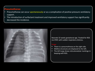 Pneumothorax
• Pneumothorax can occur spontaneously or as a complication of positive pressure ventilatory
support.
• The introduction of surfactant treatment and improved ventilatory support has significantly
decreased the incidence.
Neonate 32 weeks gestational age. Treated for RDS
via CPAP, with sudden respiratory distress.
Image
 There is a pneumothorax on the right side.
 Midline structures are displaced to the left.
 The left lungs shows reticulonodular markings in
keeping with RDS.
 