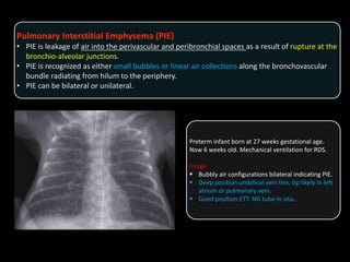 Pulmonary Interstitial Emphysema (PIE)
• PIE is leakage of air into the perivascular and peribronchial spaces as a result of rupture at the
bronchio-alveolar junctions.
• PIE is recognized as either small bubbles or linear air collections along the bronchovascular
bundle radiating from hilum to the periphery.
• PIE can be bilateral or unilateral.
Preterm infant born at 27 weeks gestational age.
Now 6 weeks old. Mechanical ventilation for RDS.
Image
 Bubbly air configurations bilateral indicating PIE.
 Deep position umbilical vein line, tip likely in left
atrium or pulmonary vein.
 Good position ETT. NG tube in situ..
 