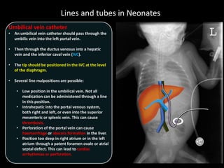 Lines and tubes in Neonates
Umbilical vein catheter
• An umbilical vein catheter should pass through the
umbilic vein into the left portal vein.
• Then through the ductus venosus into a hepatic
vein and the inferior caval vein (IVC).
• The tip should be positioned in the IVC at the level
of the diaphragm.
• Several line malpositions are possible:
• Low position in the umbilical vein. Not all
medication can be administered through a line
in this position.
• Intrahepatic into the portal venous system,
both right and left, or even into the superior
mesenteric or splenic vein. This can cause
thrombosis.
• Perforation of the portal vein can cause
haemorrhage or abscess formation in the liver.
• Position too deep in right atrium or in the left
atrium through a patent foramen ovale or atrial
septal defect. This can lead to cardiac
arrhythmias or perforation.
 