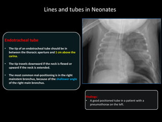Lines and tubes in Neonates
Endotracheal tube
• The tip of an endotracheal tube should be in
between the thoracic aperture and 1 cm above the
carina.
• The tip travels downward if the neck is flexed or
upward if the neck is extended.
• The most common mal-positioning is in the right
mainstem bronchus, because of the shallower angle
of the right main bronchus.
Findings:
• A good positioned tube in a patient with a
pneumothorax on the left.
 