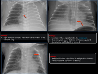 Findings:
• Right mainstem bronchus intubation with atelectasis of the
entire left lung.
Findings:
• Endotracheal tube is positioned in the right main bronchus.
• Atelectasis of left upper lobe of the lung.
Findings:
• Endotracheal tube is positioned in the oesophagus.
• Chest radiograph shows dilatation of the esophagus and
stomach, that are filled with air (arrows).
 