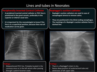 Lines and tubes in Neonates
Peripherally Inserted Central Catheter
• A peripheral inserted central catheter or PICC line is
positioned in the great vessels, preferably in the
superior or inferior caval vein.
• It is important for the neonatologist to know if the
line is in a superficial position, because then not all
medication can be given.
Findings:
• Malpositioned PICC line. Probably located in the
coronary sinus or in the left atrium after passing
through a patent foramen ovale.
Reploggel's suction catheter
• Replogle's suction catheters are used in case of
oesophageal atresia to remove saliva.
• They are positioned in the blind ending oesophagus.
• The markings of a Replogle's suction catheter form a
dashed line.
Findings:
• There is a Reploggel's drain in situ.
• Notice deep position of endotracheal tube and
atelectasis of left upper lobe.
 