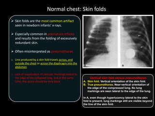 Normal chest: Skin folds
 Skin folds are the most common artifact
seen in newborn infants’ x-rays.
 Especially common in premature infants
and results from the folding of excessively
redundant skin.
 Often misinterpreted as pneumothorax
o Line produced by a skin fold travels across, and
outside the chest or across the diaphragm into the
abdomen
o Lack of visualization of vascular markings lateral to
the edge of the collapsed lung, and at the same
time, this space should be very black
Vertical skin fold versus pneumothorax
A. Skin fold. Vertical orientation of the skin fold.
B. True pneumothorax. Near-vertical orientation of
the edge of the compressed lung. No lung
markings are seen lateral to the edge of the lung.
In A, even though hyperlucency lateral to the skin
fold is present, lung markings still are visible beyond
the line of the skin fold.
 