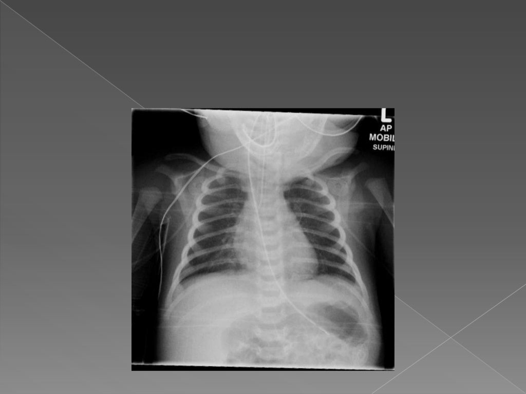 Neonatal chest x ray reading