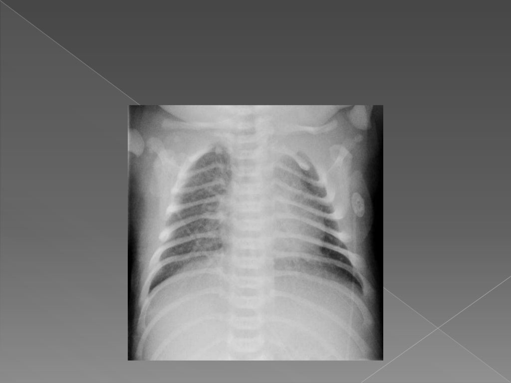 Neonatal chest x ray reading