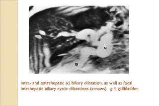 f/o biliary atresia:f/o biliary atresia:
Proliferation of proximal ductules.
Bile plugs.
Portal tract lymphatics and ar...