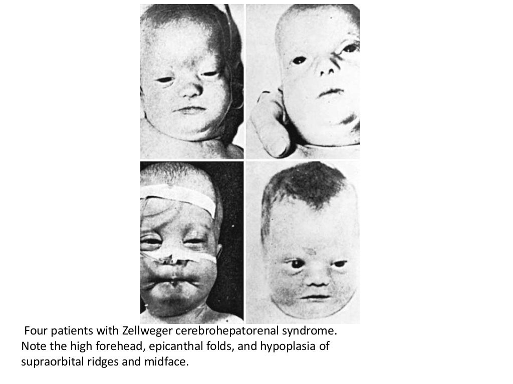 PPT on Neonatal cholestasis by Dr.ajay k chourasia