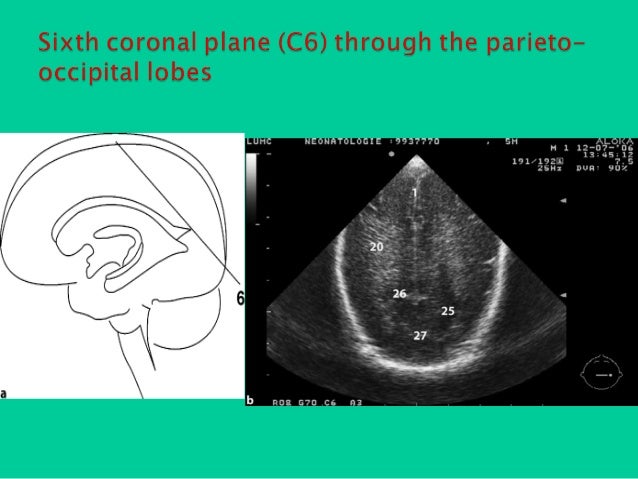 Neonatal cranial us from A to Z