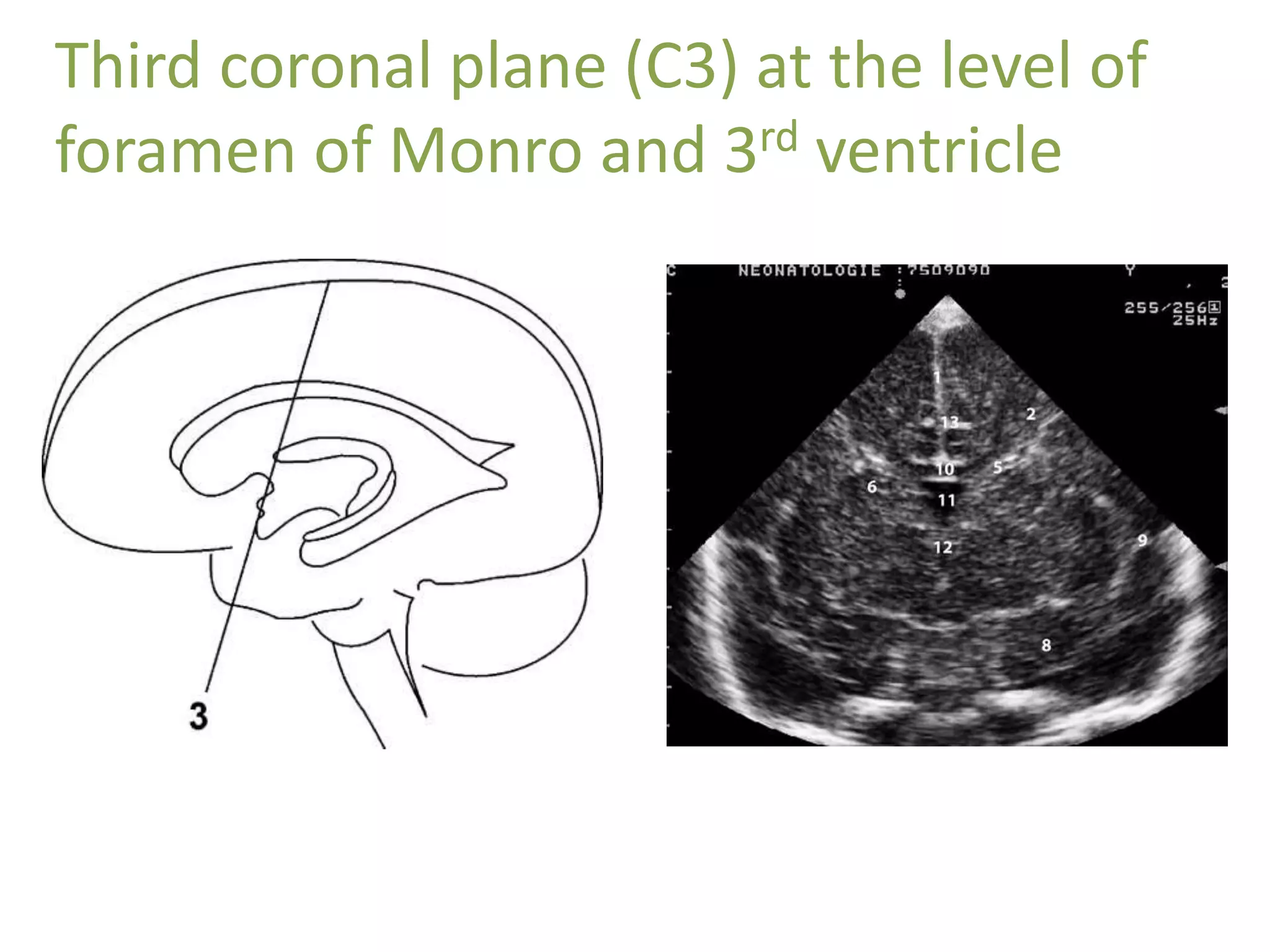 Third coronal plane (C3) at the level of
foramen of Monro and 3rd ventricle
 
