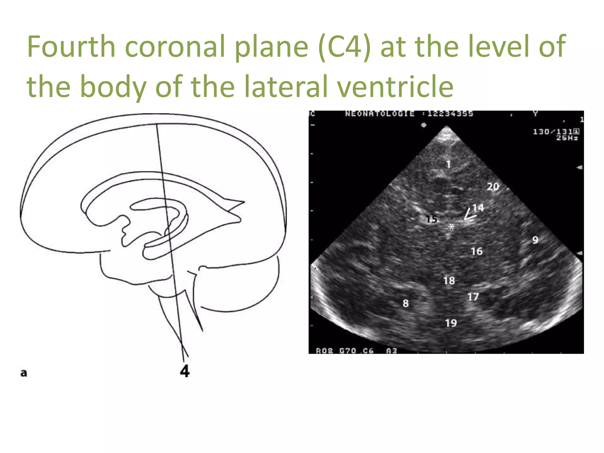Fourth coronal plane (C4) at the level of
the body of the lateral ventricle
 