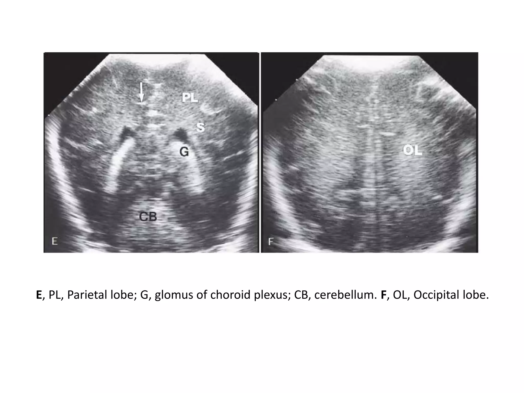 E, PL, Parietal lobe; G, glomus of choroid plexus; CB, cerebellum. F, OL, Occipital lobe.
 