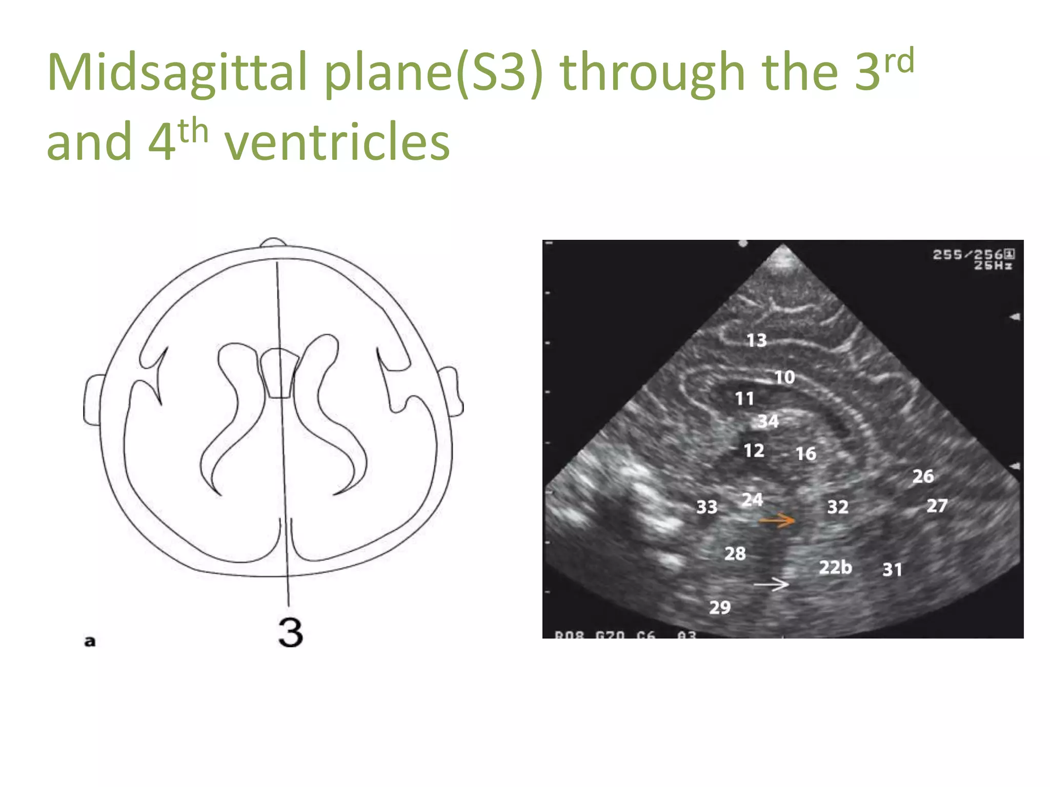 Midsagittal plane(S3) through the 3rd
and 4th ventricles
 