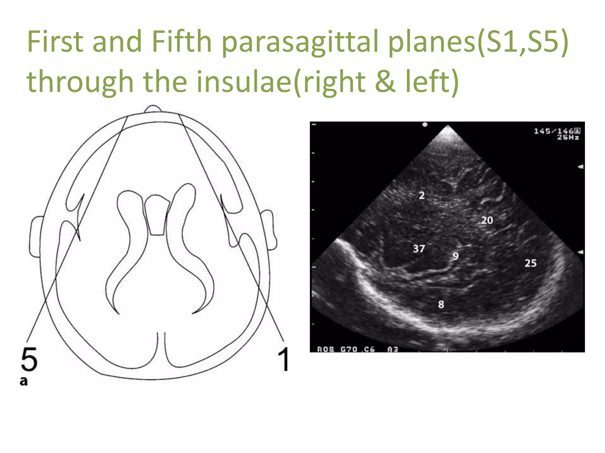 First and Fifth parasagittal planes(S1,S5)
through the insulae(right & left)
 