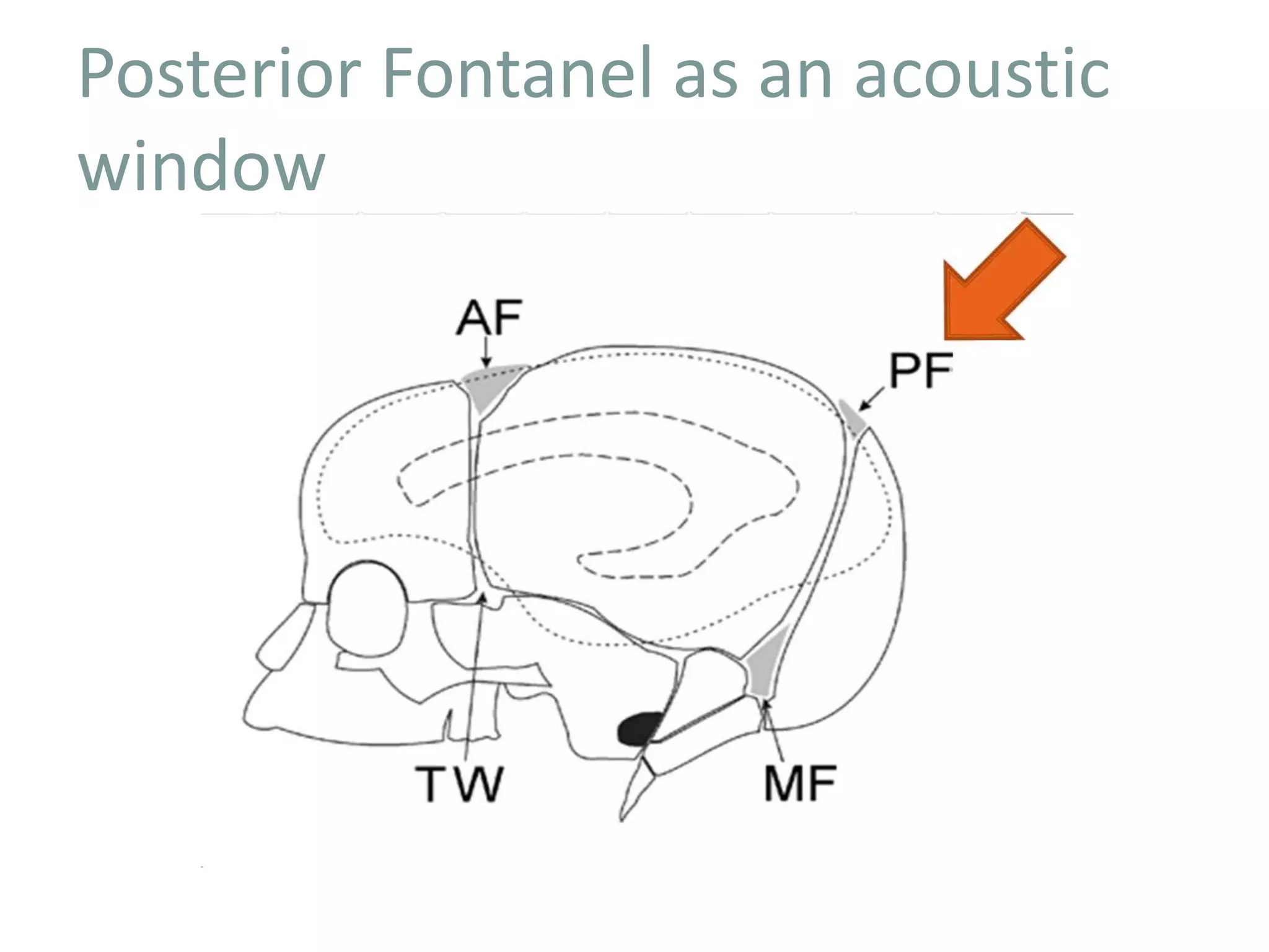 Posterior Fontanel as an acoustic
window
 