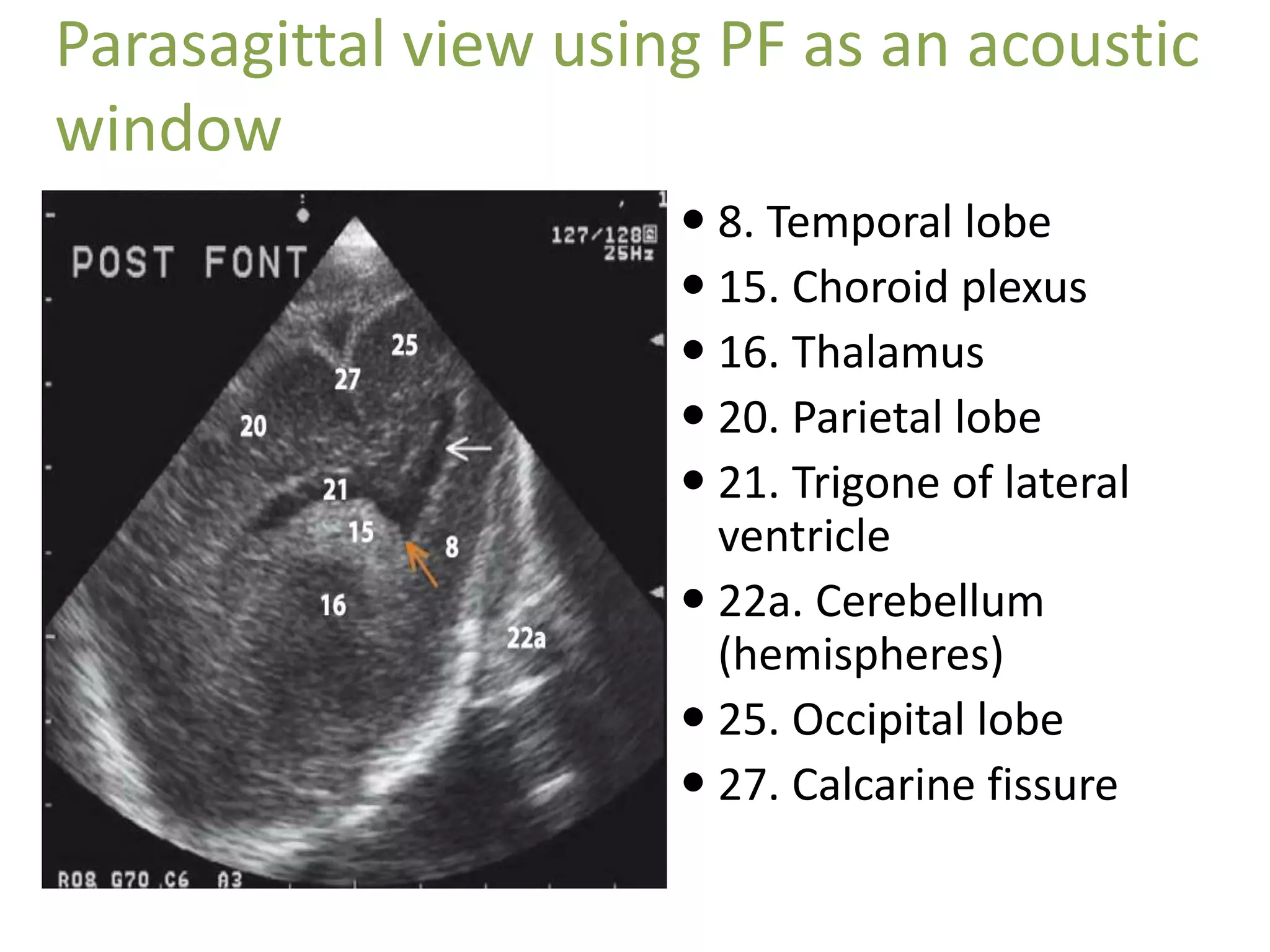 Parasagittal view using PF as an acoustic
window
 8. Temporal lobe
 15. Choroid plexus
 16. Thalamus
 20. Parietal lobe
 21. Trigone of lateral
ventricle
 22a. Cerebellum
(hemispheres)
 25. Occipital lobe
 27. Calcarine fissure
 
