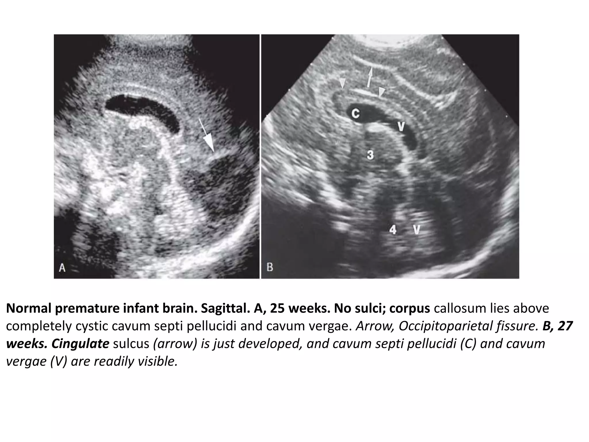 Normal premature infant brain. Sagittal. A, 25 weeks. No sulci; corpus callosum lies above
completely cystic cavum septi pellucidi and cavum vergae. Arrow, Occipitoparietal fissure. B, 27
weeks. Cingulate sulcus (arrow) is just developed, and cavum septi pellucidi (C) and cavum
vergae (V) are readily visible.
 
