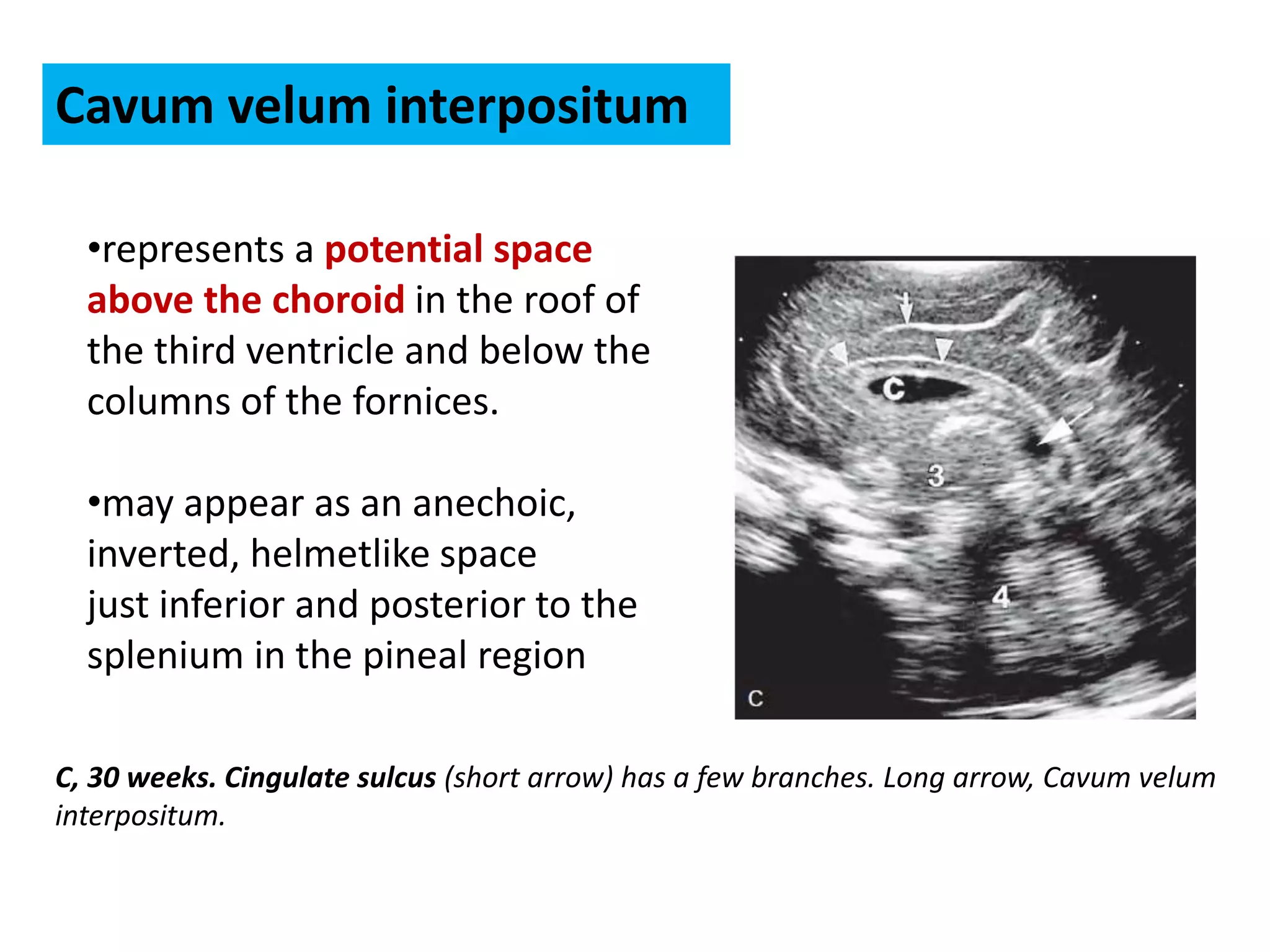 C, 30 weeks. Cingulate sulcus (short arrow) has a few branches. Long arrow, Cavum velum
interpositum.
•represents a potential space
above the choroid in the roof of
the third ventricle and below the
columns of the fornices.
•may appear as an anechoic,
inverted, helmetlike space
just inferior and posterior to the
splenium in the pineal region
Cavum velum interpositum
 