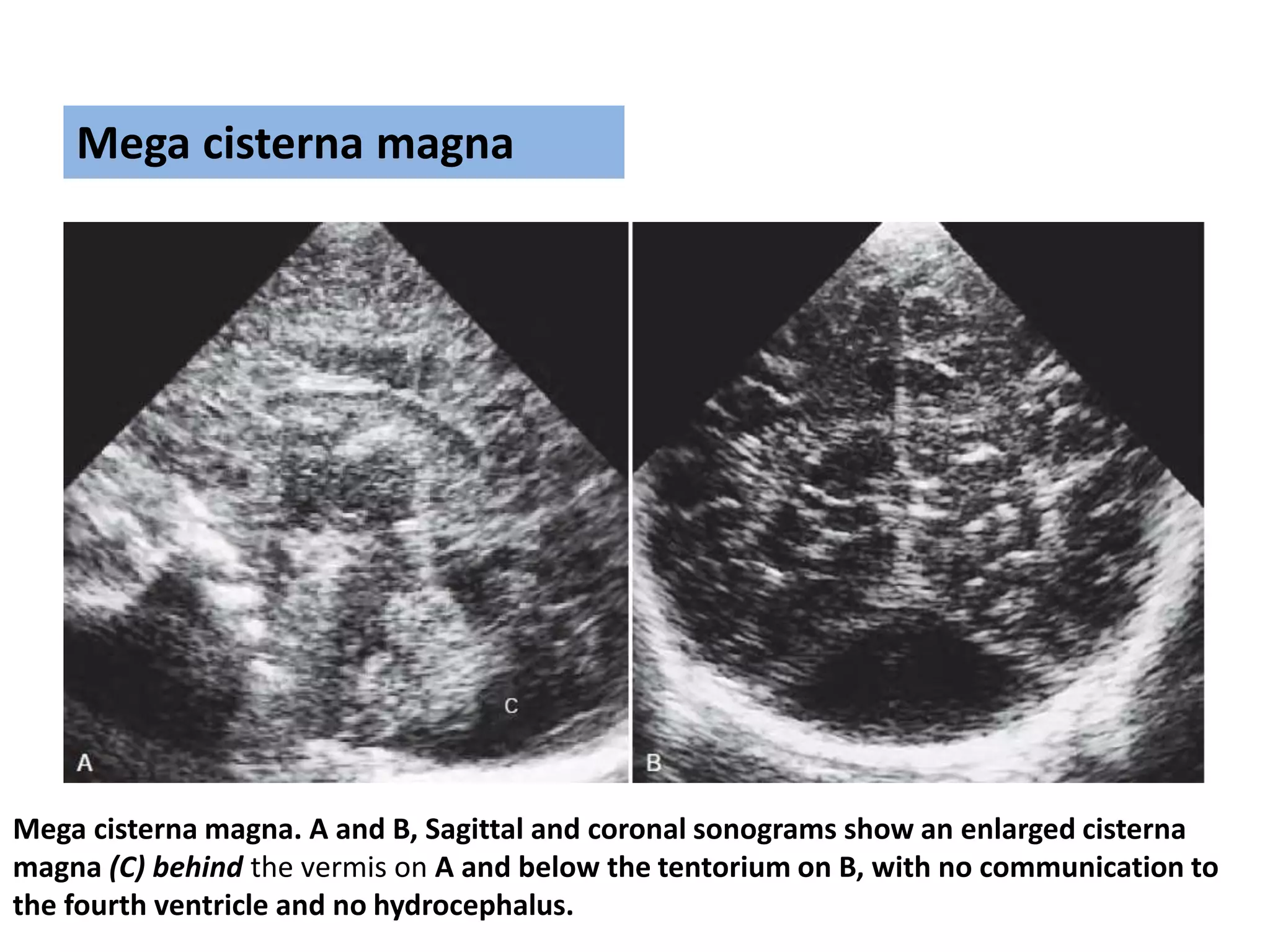 Mega cisterna magna. A and B, Sagittal and coronal sonograms show an enlarged cisterna
magna (C) behind the vermis on A and below the tentorium on B, with no communication to
the fourth ventricle and no hydrocephalus.
Mega cisterna magna
 