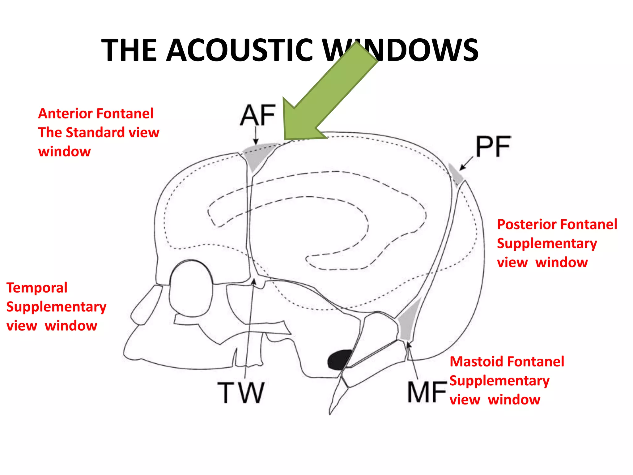 THE ACOUSTIC WINDOWS
Anterior Fontanel
The Standard view
window
Posterior Fontanel
Supplementary
view window
Mastoid Fontanel
Supplementary
view window
Temporal
Supplementary
view window
 