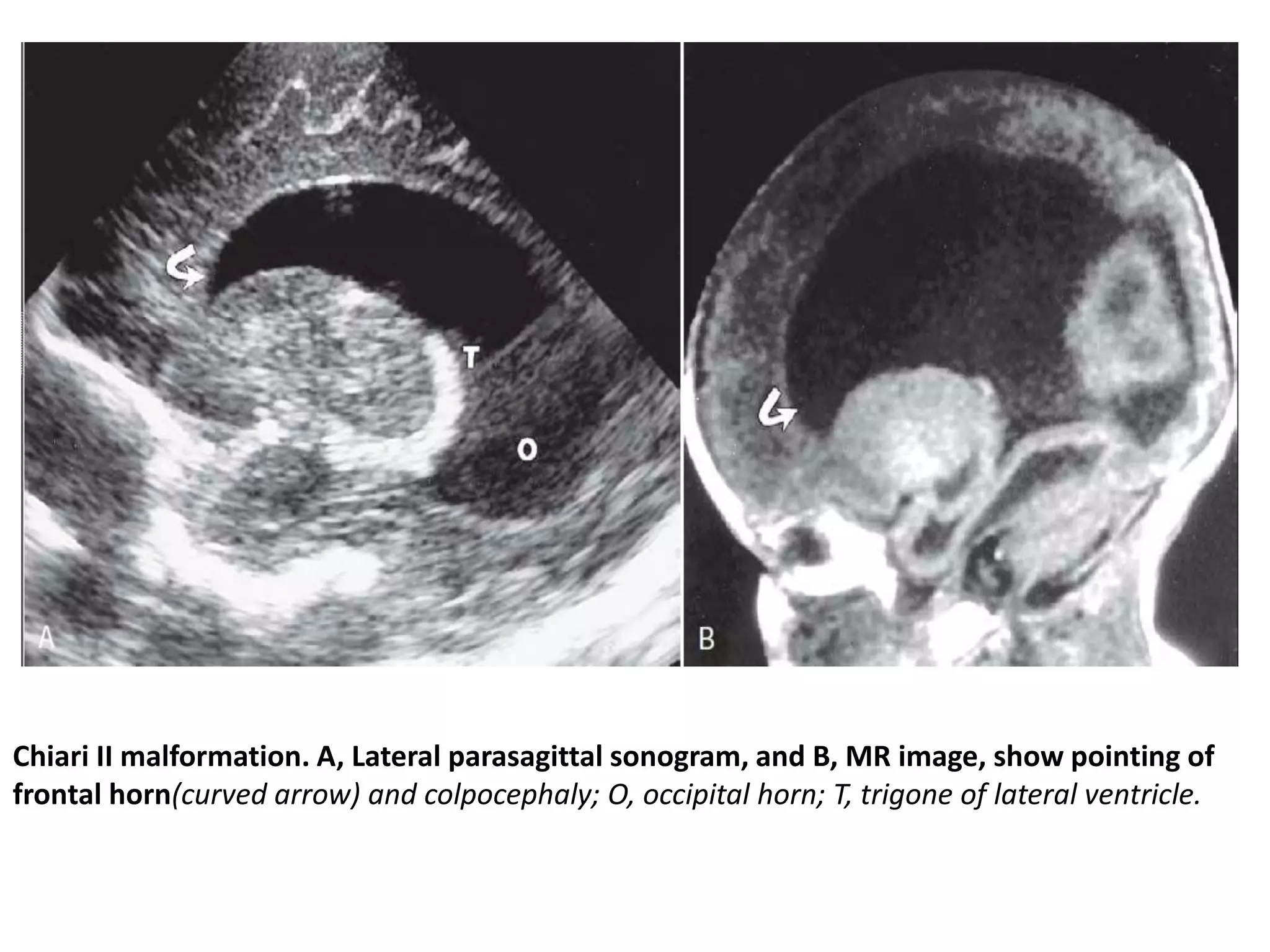 Chiari II malformation. A, Lateral parasagittal sonogram, and B, MR image, show pointing of
frontal horn(curved arrow) and colpocephaly; O, occipital horn; T, trigone of lateral ventricle.
 