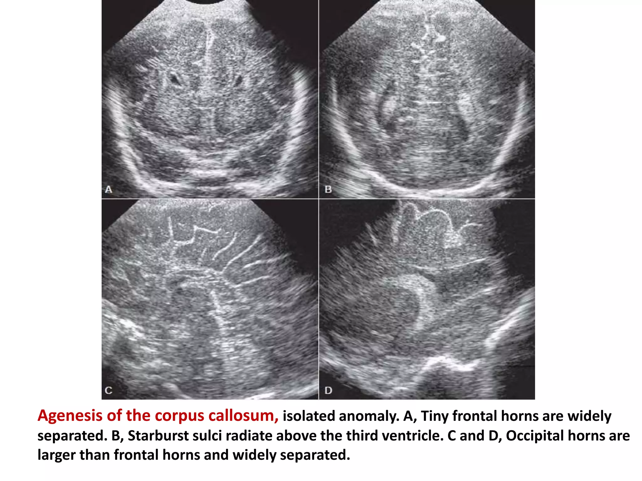 Agenesis of the corpus callosum, isolated anomaly. A, Tiny frontal horns are widely
separated. B, Starburst sulci radiate above the third ventricle. C and D, Occipital horns are
larger than frontal horns and widely separated.
 