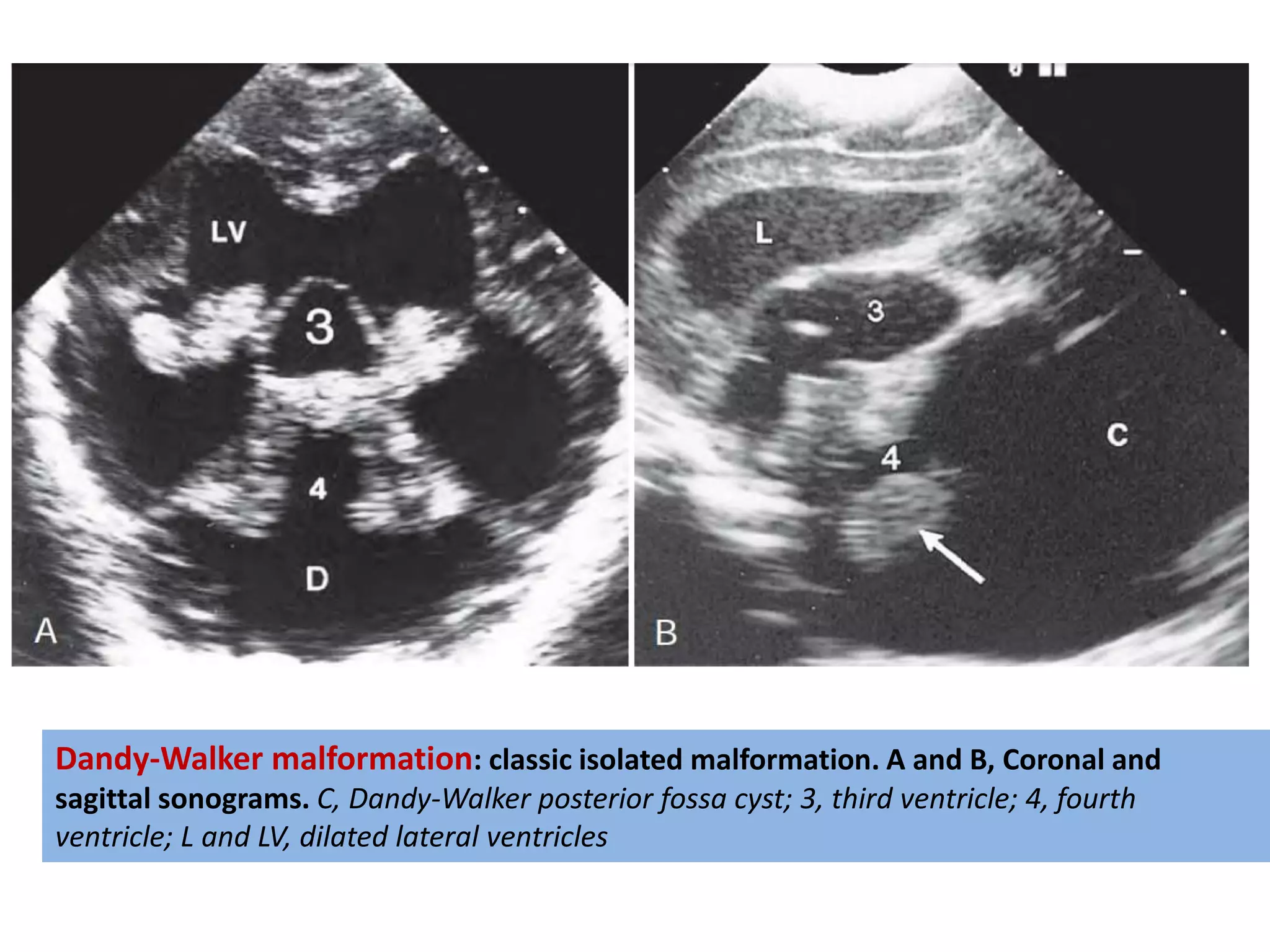 Dandy-Walker malformation: classic isolated malformation. A and B, Coronal and
sagittal sonograms. C, Dandy-Walker posterior fossa cyst; 3, third ventricle; 4, fourth
ventricle; L and LV, dilated lateral ventricles
 