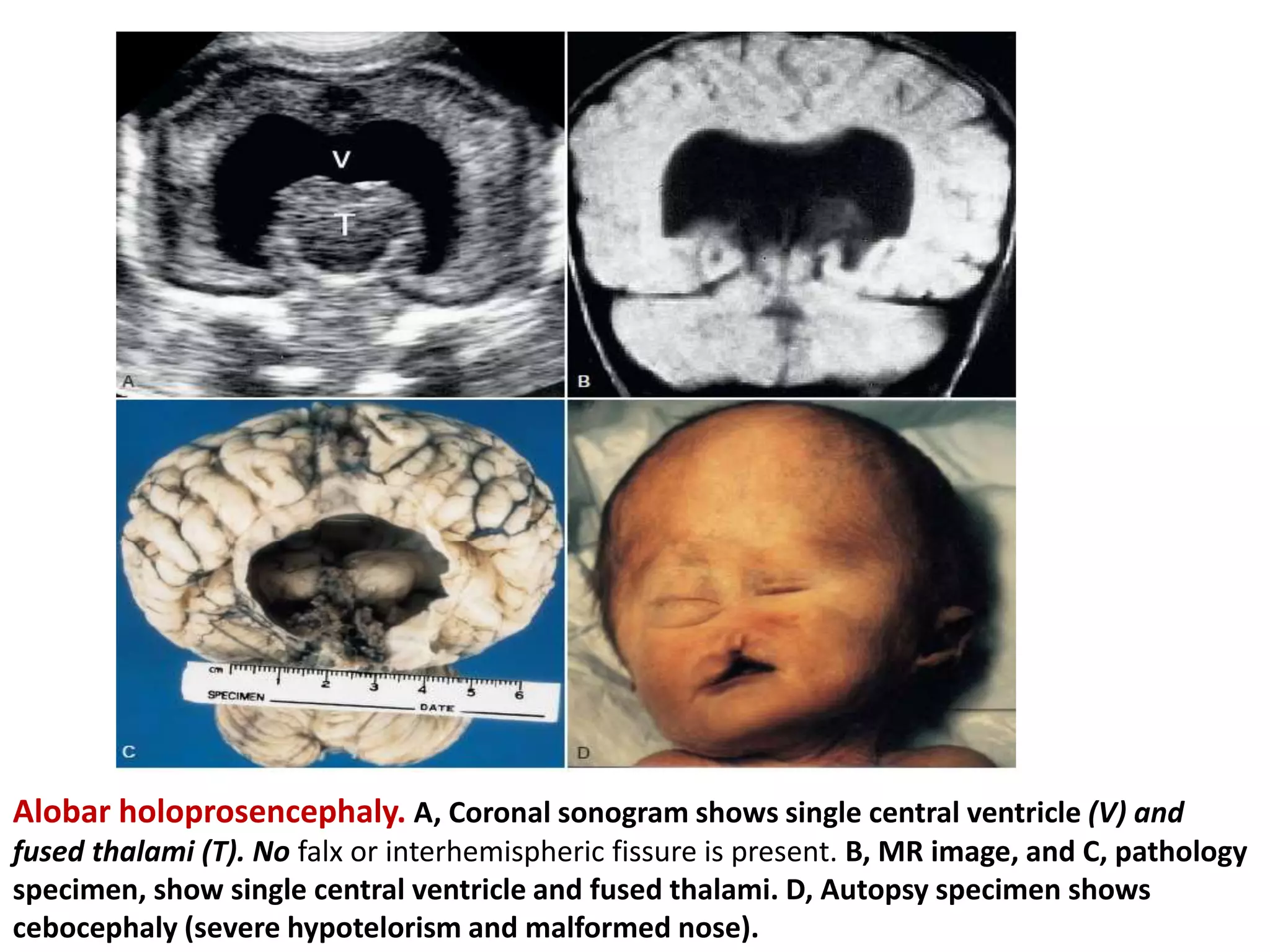 Alobar holoprosencephaly. A, Coronal sonogram shows single central ventricle (V) and
fused thalami (T). No falx or interhemispheric fissure is present. B, MR image, and C, pathology
specimen, show single central ventricle and fused thalami. D, Autopsy specimen shows
cebocephaly (severe hypotelorism and malformed nose).
 