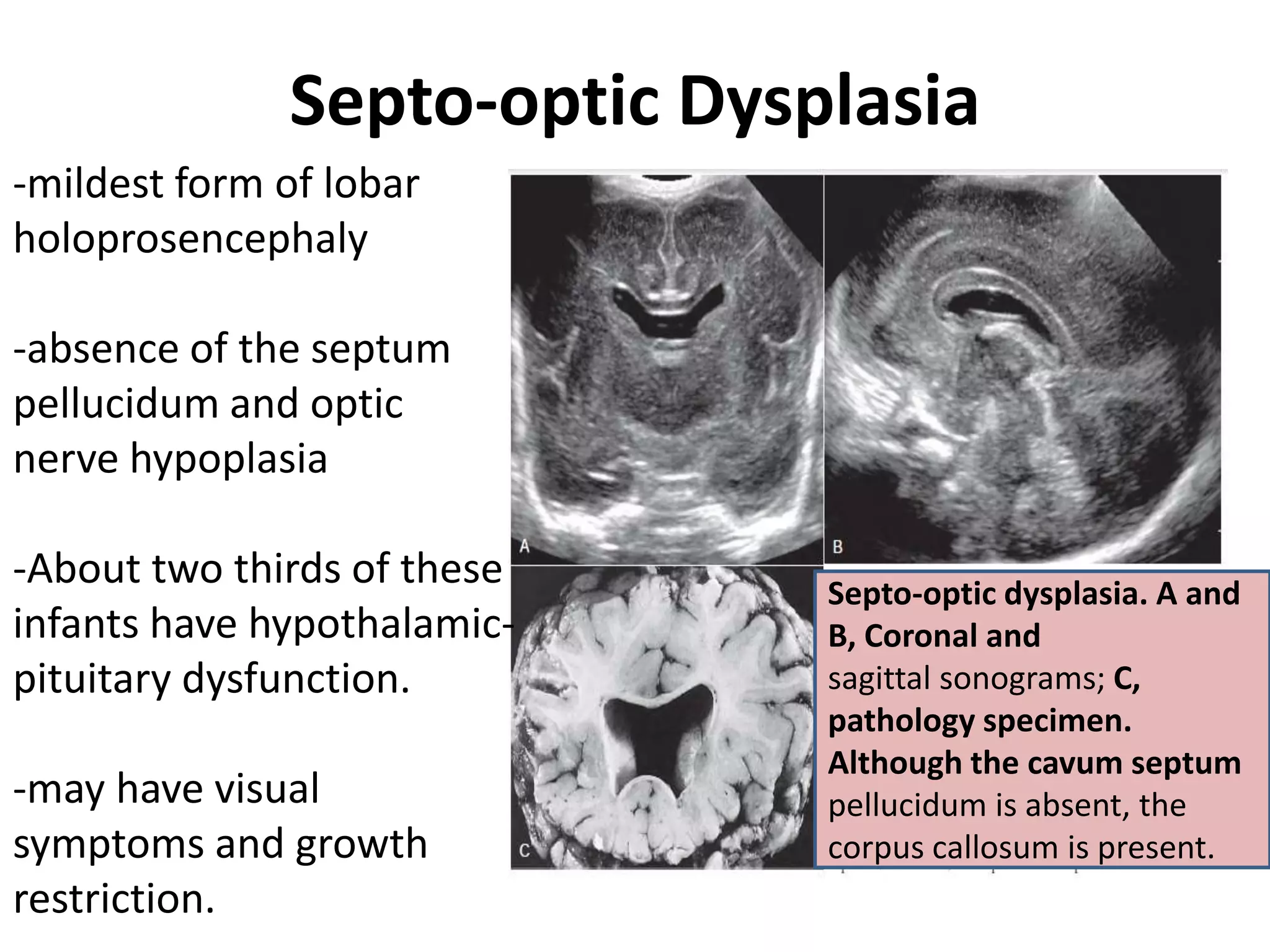 Septo-optic Dysplasia
Septo-optic dysplasia. A and
B, Coronal and
sagittal sonograms; C,
pathology specimen.
Although the cavum septum
pellucidum is absent, the
corpus callosum is present.
-mildest form of lobar
holoprosencephaly
-absence of the septum
pellucidum and optic
nerve hypoplasia
-About two thirds of these
infants have hypothalamic-
pituitary dysfunction.
-may have visual
symptoms and growth
restriction.
 