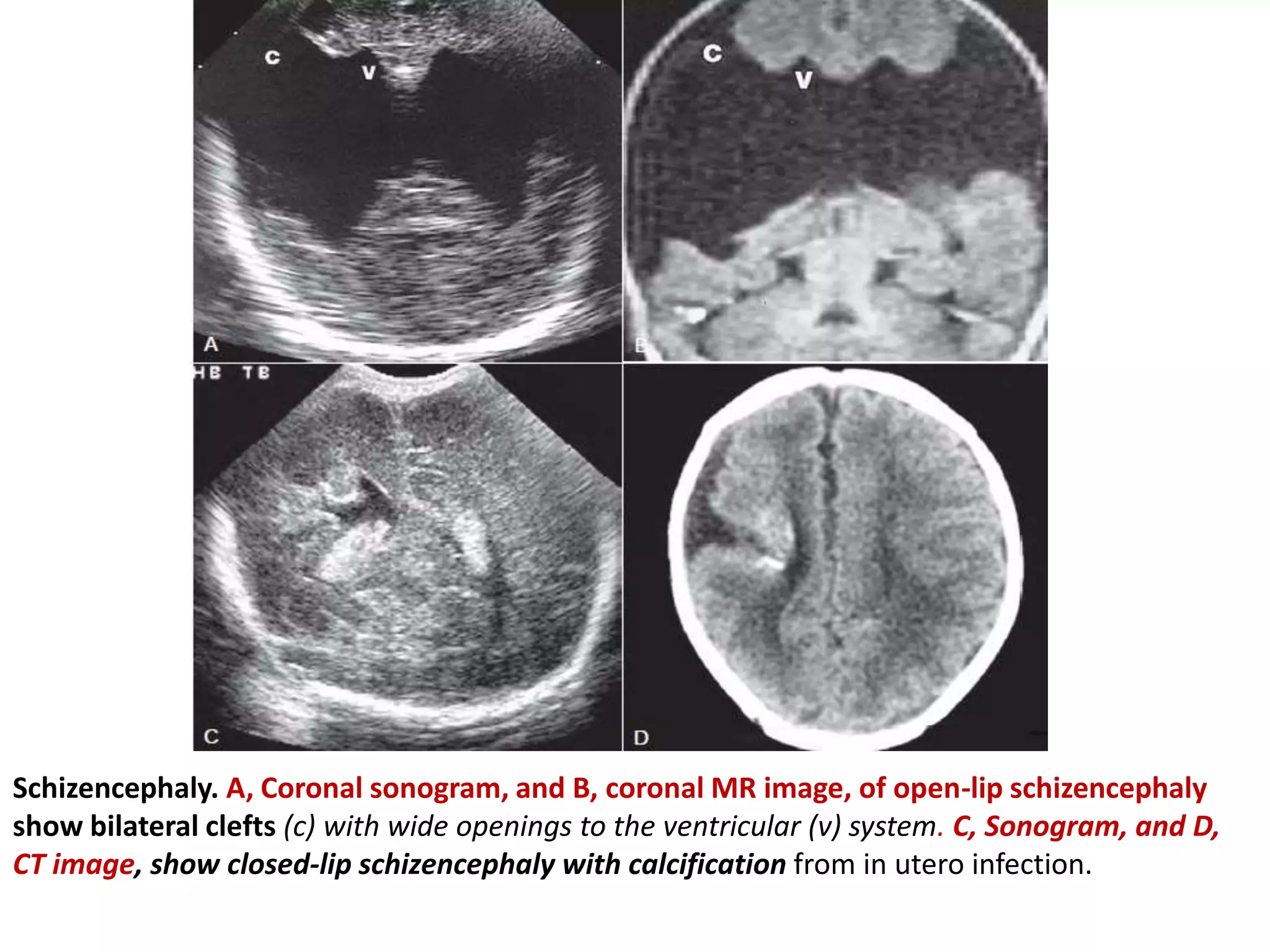 Schizencephaly. A, Coronal sonogram, and B, coronal MR image, of open-lip schizencephaly
show bilateral clefts (c) with wide openings to the ventricular (v) system. C, Sonogram, and D,
CT image, show closed-lip schizencephaly with calcification from in utero infection.
 