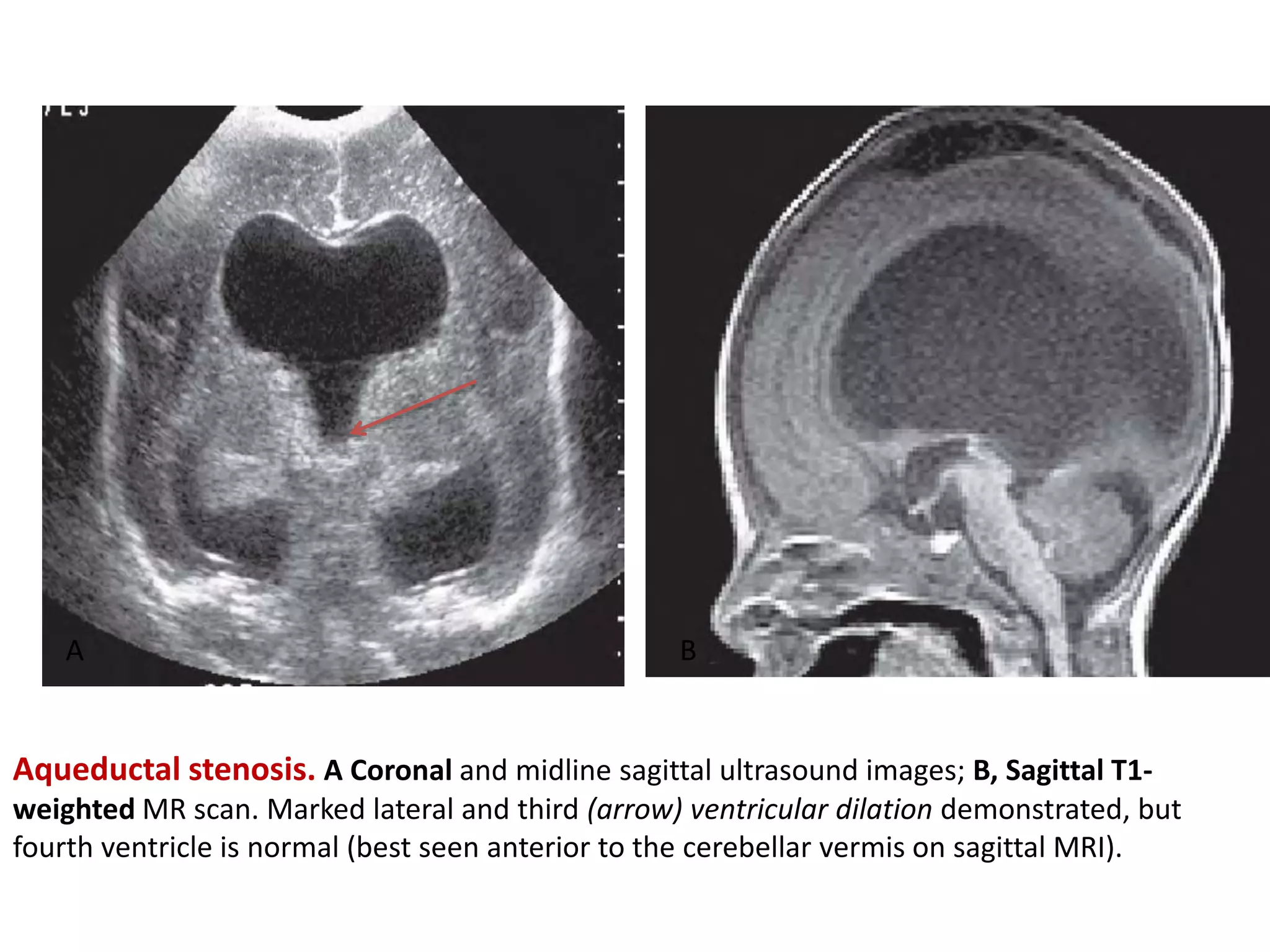 Aqueductal stenosis. A Coronal and midline sagittal ultrasound images; B, Sagittal T1-
weighted MR scan. Marked lateral and third (arrow) ventricular dilation demonstrated, but
fourth ventricle is normal (best seen anterior to the cerebellar vermis on sagittal MRI).
A B
 