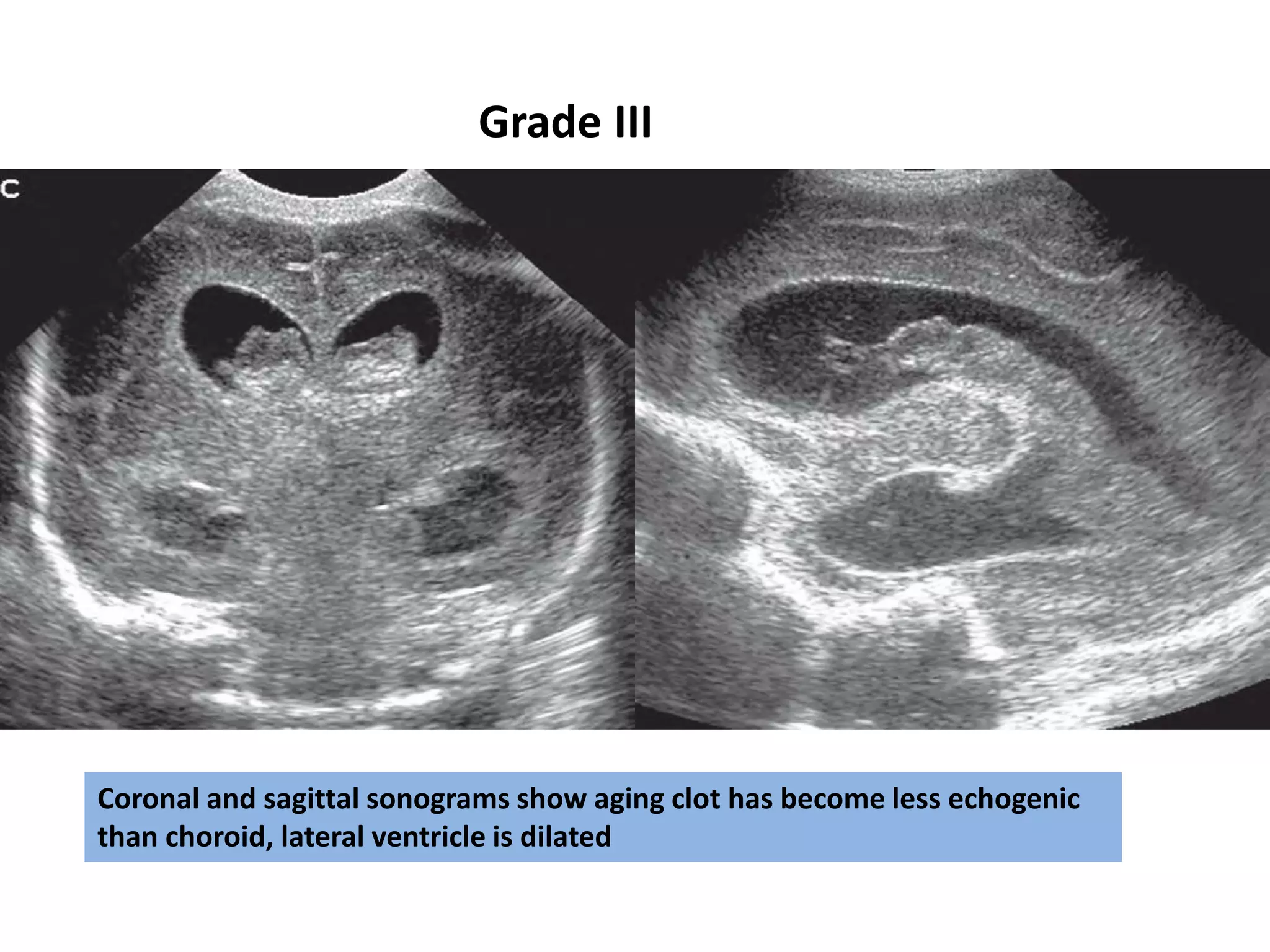 Coronal and sagittal sonograms show aging clot has become less echogenic
than choroid, lateral ventricle is dilated
Grade III
 