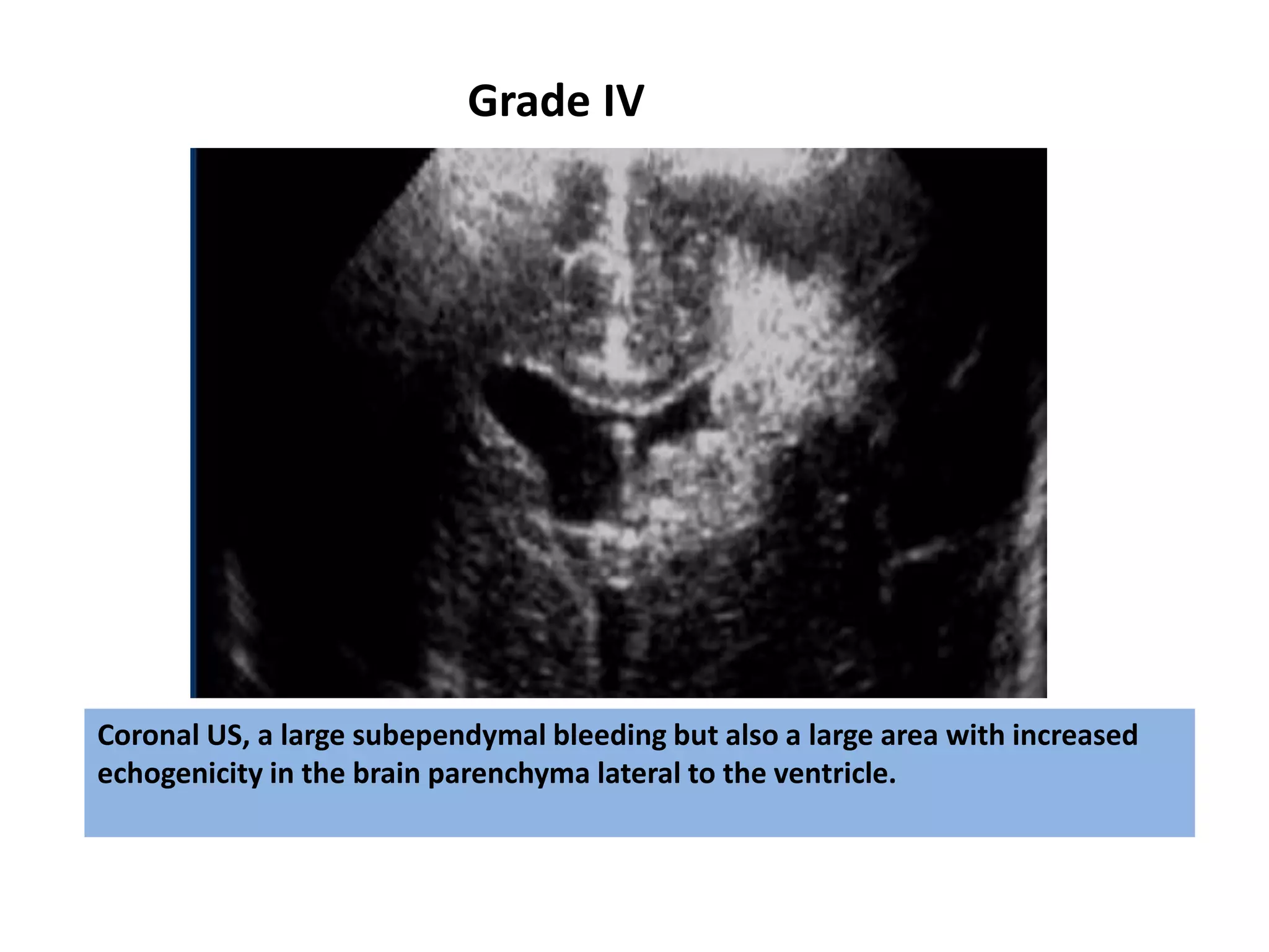 Coronal US, a large subependymal bleeding but also a large area with increased
echogenicity in the brain parenchyma lateral to the ventricle.
Grade IV
 