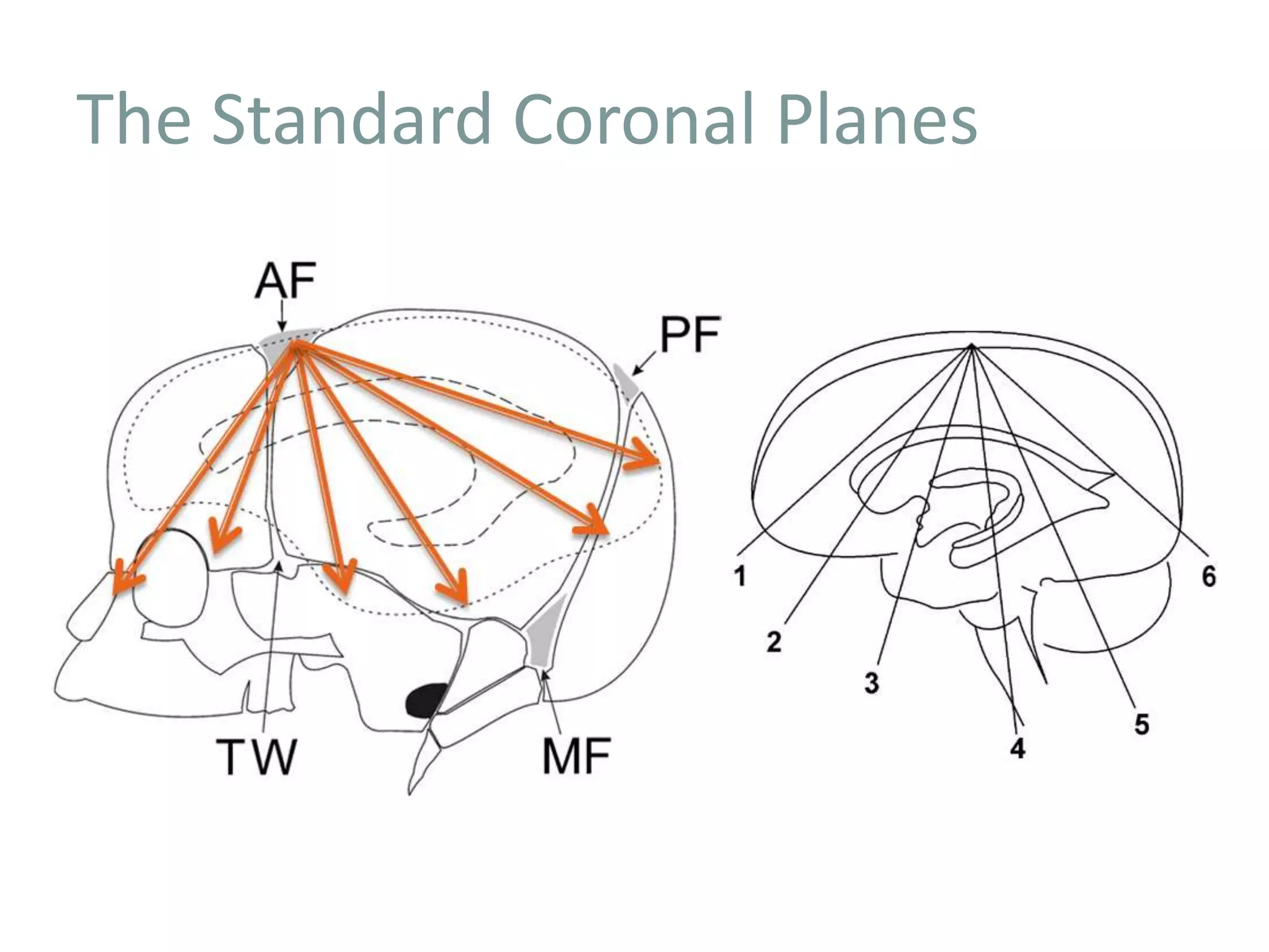 The Standard Coronal Planes
 