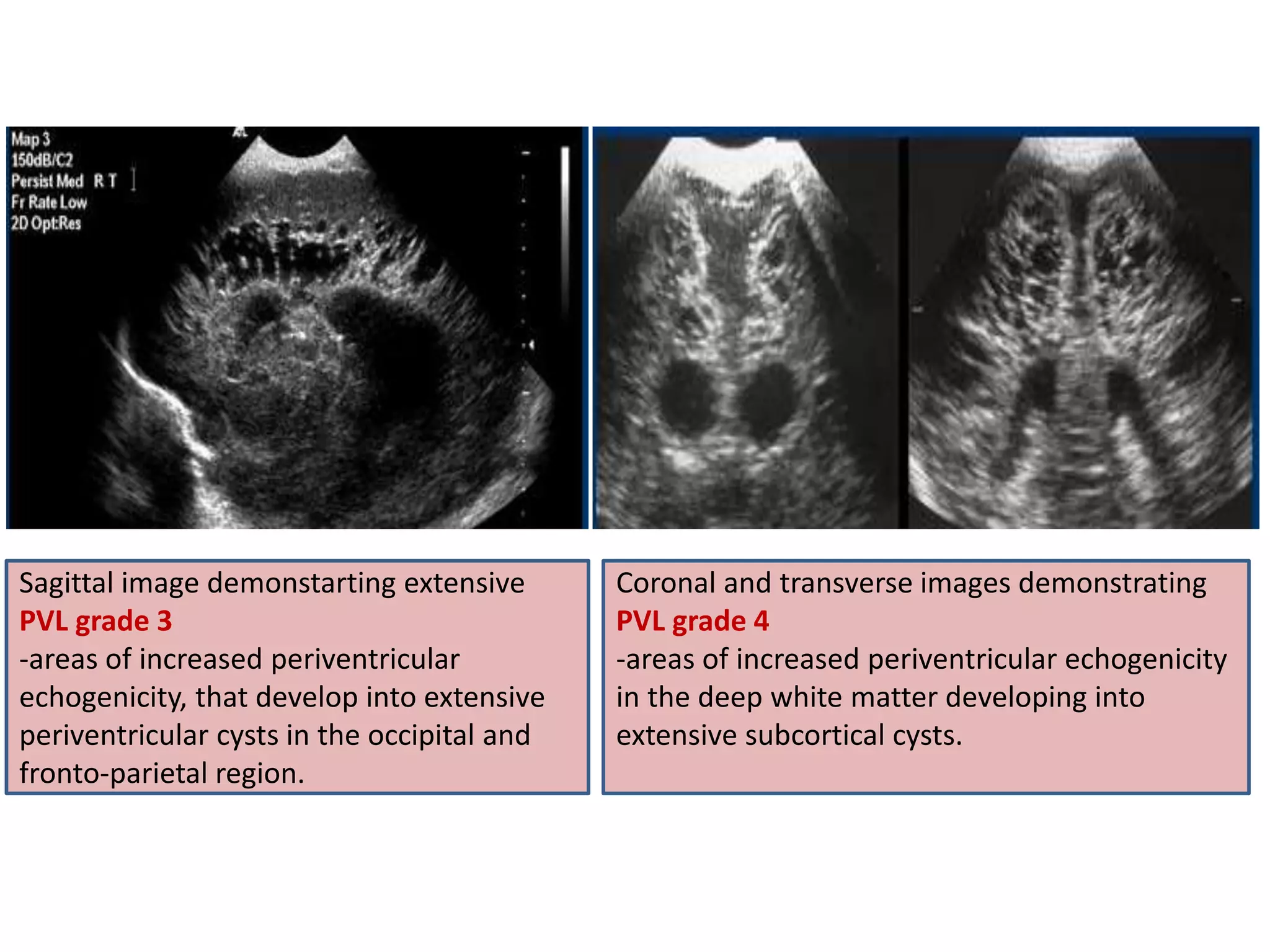 Sagittal image demonstarting extensive
PVL grade 3
-areas of increased periventricular
echogenicity, that develop into extensive
periventricular cysts in the occipital and
fronto-parietal region.
Coronal and transverse images demonstrating
PVL grade 4
-areas of increased periventricular echogenicity
in the deep white matter developing into
extensive subcortical cysts.
 