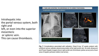 Intrahepatic into
the portal venous system, both
right and
left, or even into the superior
mesenteric
or splenic vein.
This can cause thrombosis.
 