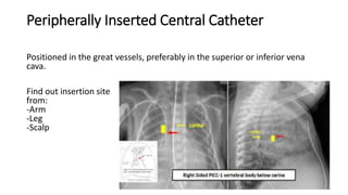 Peripherally Inserted Central Catheter
Positioned in the great vessels, preferably in the superior or inferior vena
cava.
Find out insertion site
from:
-Arm
-Leg
-Scalp
 