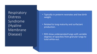Respiratory
Distress
Syndrome
(Hyaline
Membrane
Disease)
• Typically in preterm neonates and low birth
weight.
• Related to lung maturity and surfactant
production.
• RDS show underaerated lungs with variable
degrees of opacities from granular lungs to
total white-out.
 