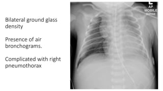 Air Bronchogram Rds Neonatal Chest X-Ray | PPTX