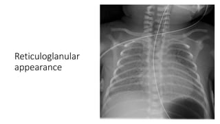 Reticuloglanular
appearance
 
