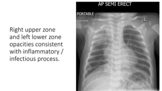 Right upper zone
and left lower zone
opacities consistent
with inflammatory /
infectious process.
 
