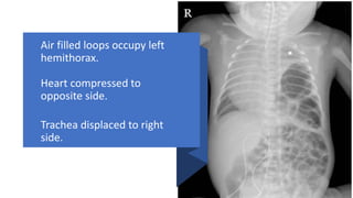 Air filled loops occupy left
hemithorax.
Heart compressed to
opposite side.
Trachea displaced to right
side.
 
