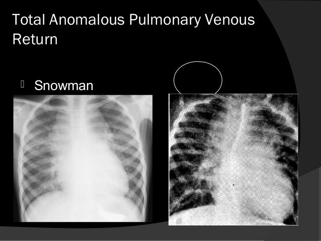 Approach To A Neonate With Cyanosis